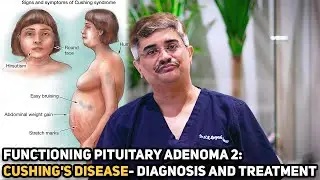 Functioning pituitary adenoma 2: Cushing's Disease-Diagnosis and treatment | Dr.Roopesh Kumar