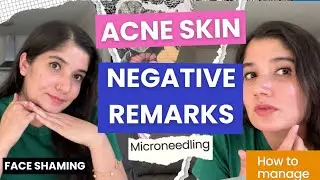Acne Skin | Negative Comments | How it affected me | Tips to overcome | Microneedling | Skincare |