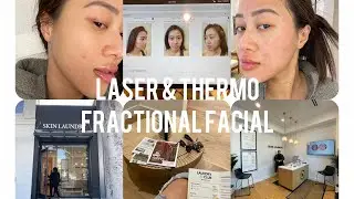 First laser & Thermo Fractional facial experience at Skin Laundry I What's Thermo Fractional facial?