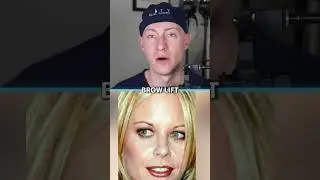 Meg Ryan's NEW FACE | Plastic Surgery Analysis