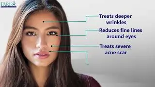 Fractional CO2 Laser Treatment | Know benefits and much more | Stretch Marks Reduction Treatment