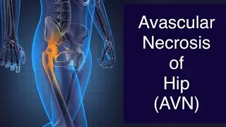 Hip Joint Pain | Avascular Necrosis of hip | AVN hip