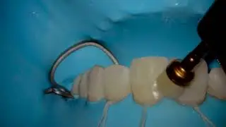 Icon White Spot Lesion Treatment - Step 3: Polishing