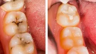 የጥርስ ሙሌት ለምን ያማል?