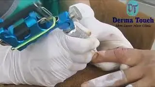 Derma Touch Micropigmentation Treatment for Vitiligo/White patches