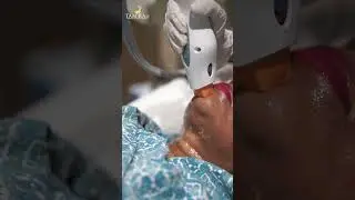 Thermage for Skin Tightening #shorts