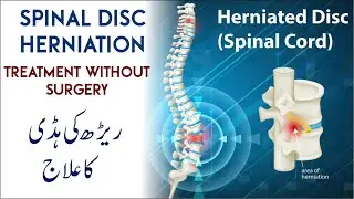 Spinal Disc Herniation | Causes, Symptoms & Treatment | Diet & Supplement Urdu | Lower Back Pain