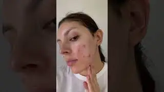 Journey to Clear Skin #acneprone #acnepositivity #acneproneskin #acneskincare #clearskin