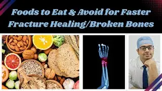 What to Eat After a Fracture | Bone Healing Foods, Myths & Recovery Tips