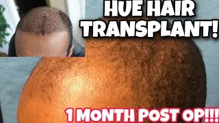1 MONTH POST OP UPDATE ON MY HUE TRANSPLANT!!!
