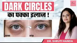 How to remove dark circles | Dark Circles का Permanent इलाज  |  Dr Shruti Handa