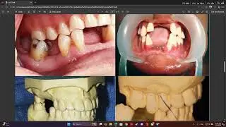 partial denture 11 (ESTABLISHMENT OF OCCLUSAL RELATIONSHIP for RPD)
