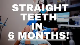 Six Month Smiles // Get Your Dream Smile In Six Months // Dentist Near Me// Dentist Open on Saturday