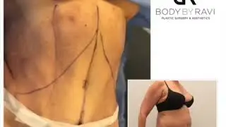 Check Out This Hi Definition Tummy Tuck Revision by Dr. Ravi