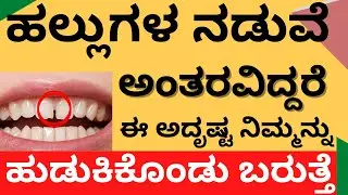 ಹಲ್ಲುಗಳ ನಡುವೆ ಅಂತರ ಇದ್ರೆ ಅದೃಷ್ಟ ನಿಮ್ಮನ್ನು  ಹುಡುಕಿಕೊಂಡು ಬರುತ್ತೆ | gap between teeth Diastema