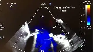 Transvalvular vs. Paravalvular Prosthetic Heart Leaks: Which Helps and Which Harms?