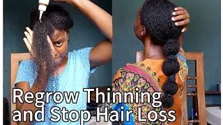 Regrow Thinning Edges & Bald Spots Naturally|Hair Growth Secrets Revealed|Stop Hair Shedding&Balding