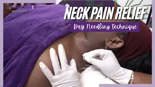 Chronic Neck Pain GONE! The Dry Needling Secret for LASTING Relief (It's Not a Massage!)