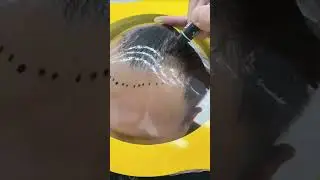 Custom Hair line to help you the hairline hair loss?#hairlinerestoration #hairregrowth