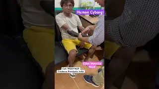 Robot Hand- Prosthetic Limb by Cyber Motorica in Delhi! Fitment at Credence Prosthetic India!
