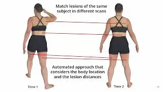 Skin3D: Detection & Longitudinal Tracking of Pigmented Skin Lesions in 3D Total-Body Textured Meshes