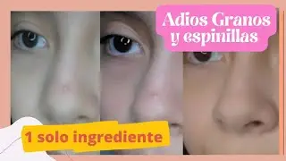 Como quitar granitos r&aacute;pido//remedio casero para eliminar el acne  #eliminaracne #acne