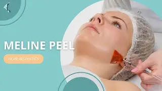 Clinica Fiore Skin Clinic London MELINE Peel