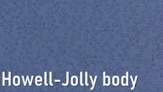 Red cells: Howell-Jolly bodies