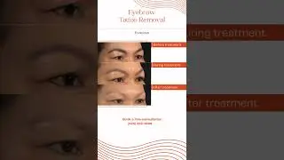 Eyebrow Tattoo Removal in Seattle - Washington