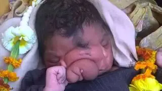 Girl born with 'elephant trunk' deformity is worshipped like a god in India