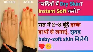  Dryness, roughness, dullness, itching&hellip;solution ||सर्दियों में dry skin को तुरंत soft करो 👍🏻&hearts;️||