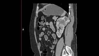 ROBOT ASSISTED LAPAROSCOPIC PARTIAL NEPHRECTOMY FOR UPPER POLAR COMPLEX TUMOR TIPS AND TRICKS