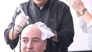 Lansarea tratamentului de micropigmentare a scalpului/ tatuaj pe chelie