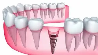 Medent Dental Implants