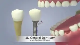 DentalEducation - 3D Dental Animated Video