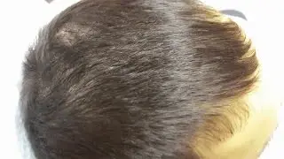 Platelet Rich Plasma Hair Loss Treatment In New York
