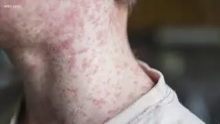 Sharp jump in measles cases in South Carolina