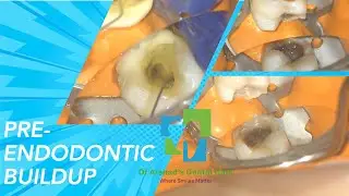 Pre Endodontic Build-Up