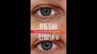 Разбор клинического случая. Орбитальный участок. Aurevitelli 3D eyes