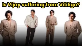 Vijay Varma: Vijay Varma on suffering from skin condition vitiligo