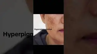For dark pimple spot use Tamanu oil #essentailoils #skincare