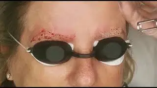 Laser Tattoo Removal, How It Works, Microblading, Removal Of Ink.