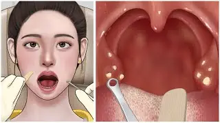 ASMR  Mouth Tonsil stone Removal Animation /#MasterASMR#asmrvideo