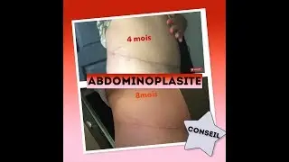 ABDOMINOPLASTIE | COMMENT GÉRER L'OEDEME ET SA CICATRICE!