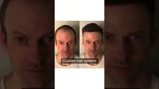 Custom hair system. A great non surgical solution for hair loss.