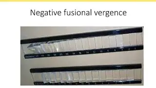 Orthopics series 4 : Negative fusional vergence (NFV)