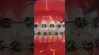 What are the different orthodontic ties and what are they used for?