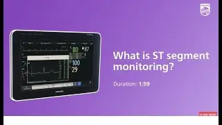 What is ST segments monitoring?