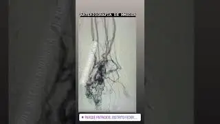 RADIOLOG&Iacute;A INTERVENCIONISTA Y HEMODINAMIA: ARTERIOGRAF&Iacute;A DE MIEMBRO SUPERIOR DERECHO