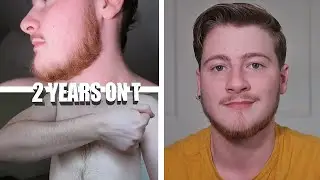 2 YEARS ON TESTOSTERONE CHANGES (BEARD, BODY, FAT, MUSCLE) FTM TRANSGENDER